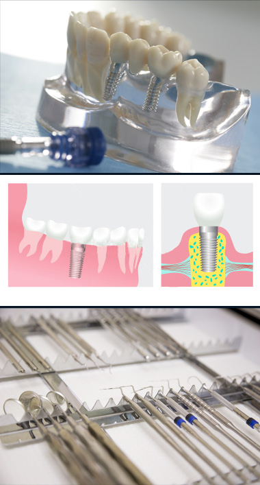 Implantate - Der Traum von Festen und natürlich aussehenden Zähne